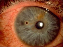 Corneal foreign body - metal with rust ring